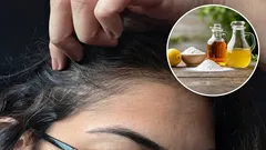 Was sind die Vorteile der Verwendung von Essig und Natron zur Entfernung grauer Haare und wie wendet man diese Methode richtig an?